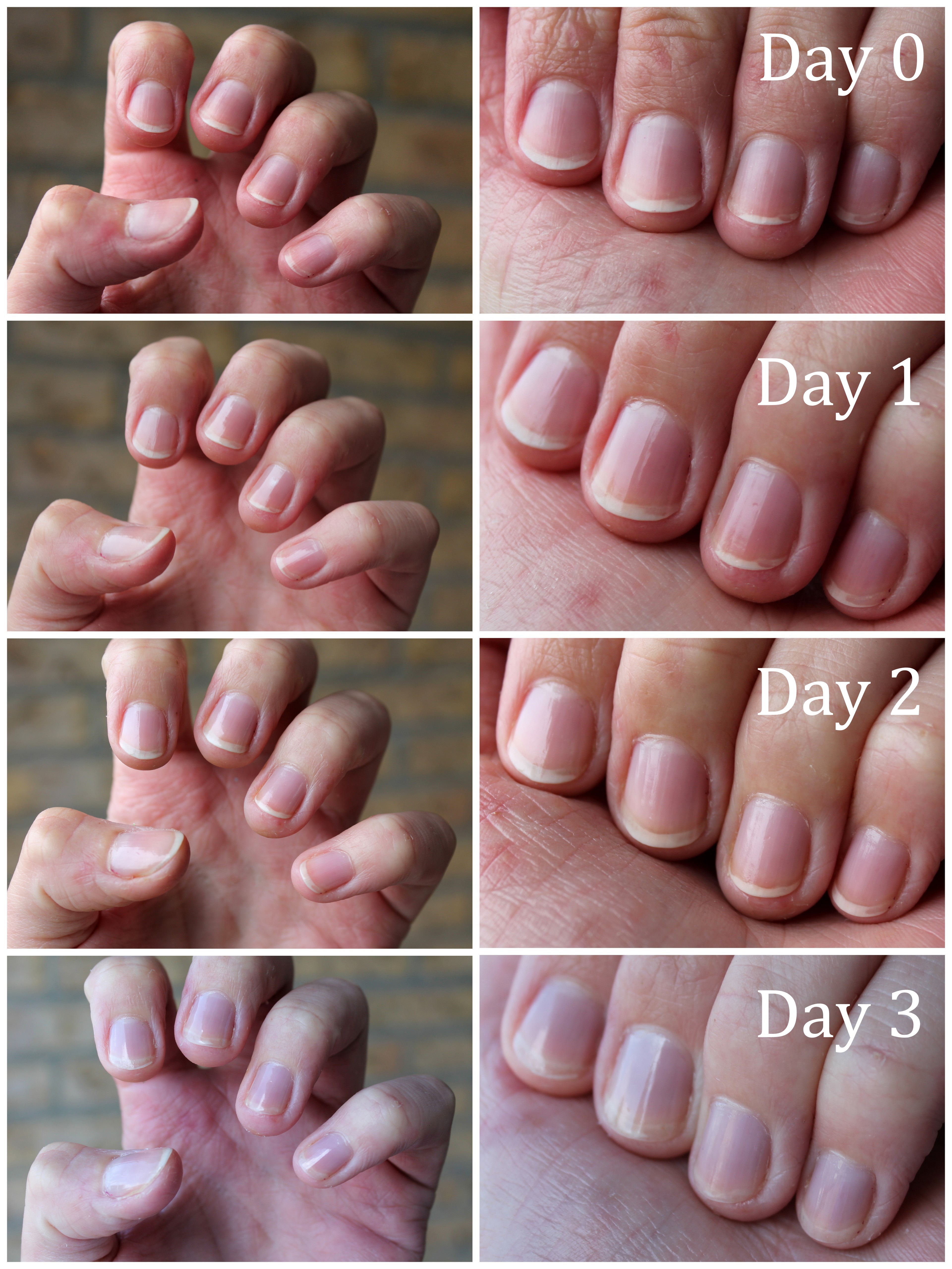 Remarkable Fast Nail Regrowth After Surgical Removal
